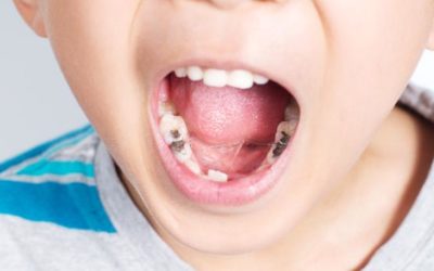 Estos son los minutos que debe durar el cepillado de tu hijo para evitar las caries