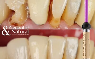 Reconstrucción Dental con Palfique LX5