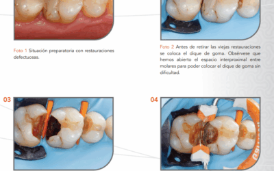 Uso de anillos Garrison Composi-Tight® 3D Fusion™ CASO del Dr. Jon Gurrea