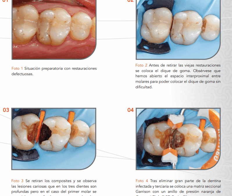 Uso de anillos Garrison Composi-Tight® 3D Fusion™ CASO del Dr. Jon Gurrea