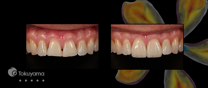Cómo crear efectos de calcificación dental de aspecto natural con resinas compuestas directas